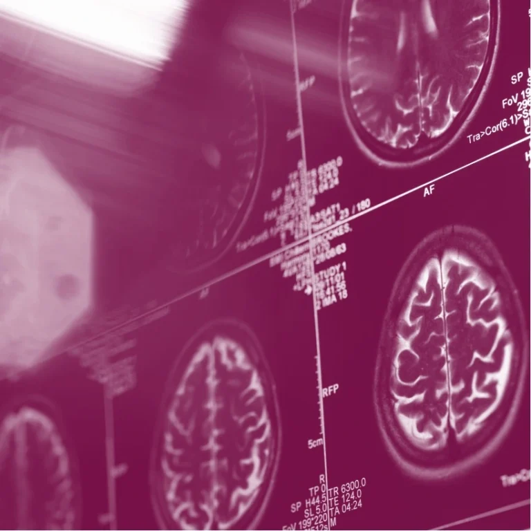 Metabolic Syndrome Linked To Faster Brain Ageing