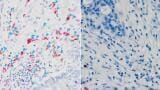 Immune molecule found to help cancer immunotherapy work from within tumours