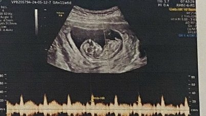Gender imbalance at birth: Stricter penalties are needed for sex selection.
