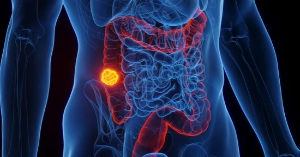 USF Health, Tampa General study finds metastatic colorectal cancer’s immune defenses may begin outside the cancer cell, challenging view held for decades USF Health, Tampa General study finds metastatic colorectal cancer’s immune defenses may begin outside the cancer cell, challenging view held for decades